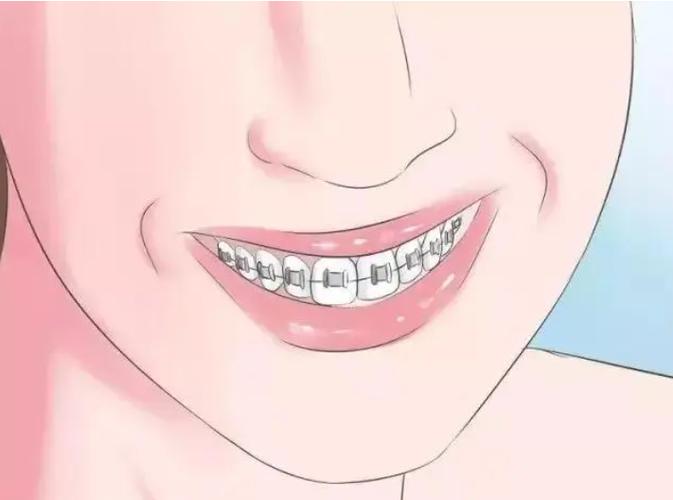 戴牙套隐适美哪个难受？牙套有几种类型？(图1)