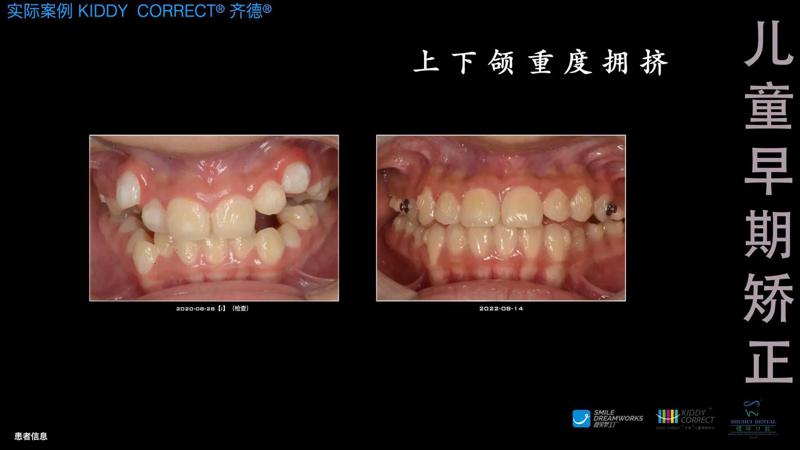 上海自锁托槽矫正医生排名实力揭晓，附牙齿矫正价格表(图1)