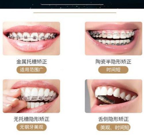 门牙缝隙变大的原因和改善方法，牙齿矫正技术怎么样，口碑评价如何？(图1)