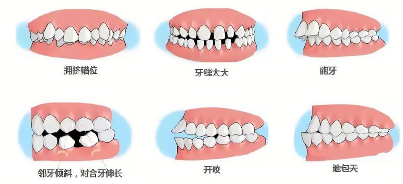 24岁牙齿矫正价格表：不同矫正方式价格表及费用多少详细介绍(图1)