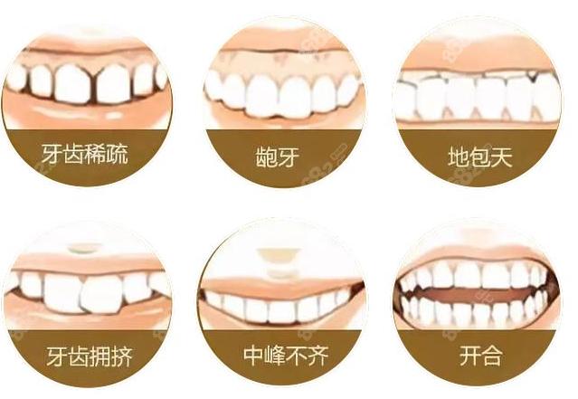 正雅咬合诱导版与早期矫治版牙套费用对比：了解不同矫正方案的价格差异(图1)
