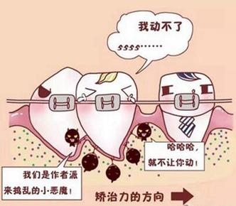 揭秘整牙效果差异：为什么有人变美有人变丑，正畸牙套脸如何应对？(图1)