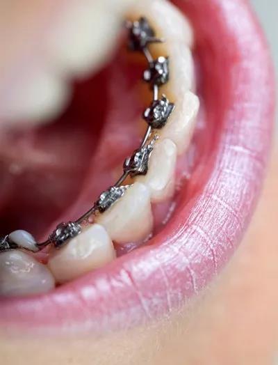 北京崇文门口腔医院的牙齿矫正技术怎么样？患者口碑评价如何