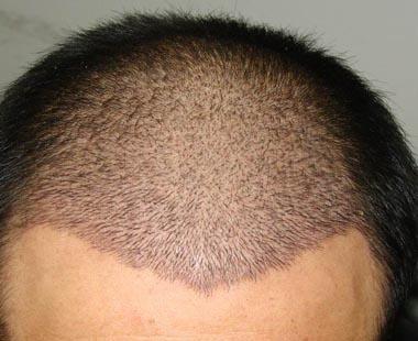 山东容妍医疗美容医院地址在哪？技术怎么样？都有哪些靠谱医生？附植发填充案例分享~(图1)