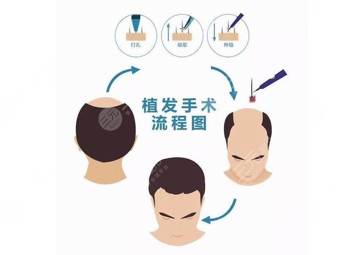 成都靠谱的植发医院是哪家？及植发费用给安排，2024年较新介绍！