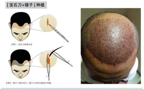 南宁植发医院怎么样，医院地址，价格表查询