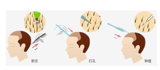 合肥植发排名都有哪些？碧莲盛、大麦微针详情介绍