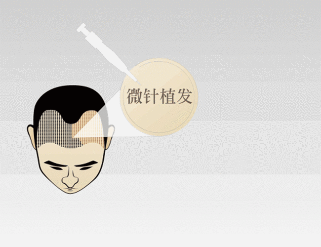 疤痕植发一般多少钱？附详细的价格标准和相关科普(图1)