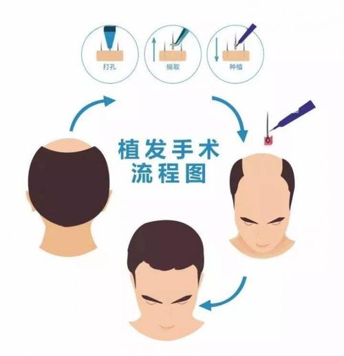 南昌毛发种植术如何呢？南昌地区名气不错的医院有这几家！