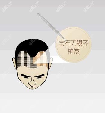 莱森植发医院怎么样，地址，价格(图1)
