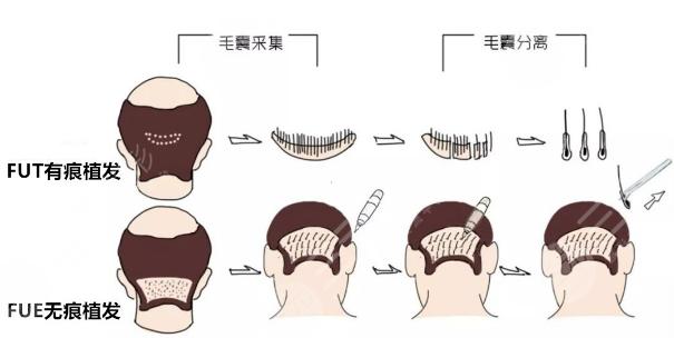 苏州名仕医院植发效果如何？从价格表和口碑评价看其正规性(图1)