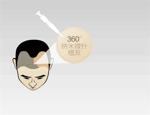 广州飞悦植发怎么样？含价格信息_口碑了解