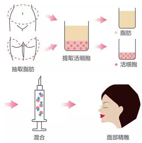 太阳凹陷怎样变饱满呢？自体脂肪填充会不会疼痛呢？(图1)
