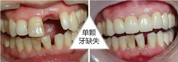 成都种植牙医生哪个比较好？排名榜前三的个个有名气，超级厉害