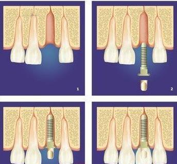 正规口腔医院种牙价格是多少？附带种植牙技术，真实案