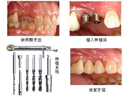 慈溪华阳口腔医院种植牙价格？内含价格表及案例分析