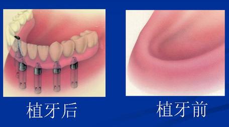 上海三甲医院种牙价目表？上海哪些三甲医院种牙做的好