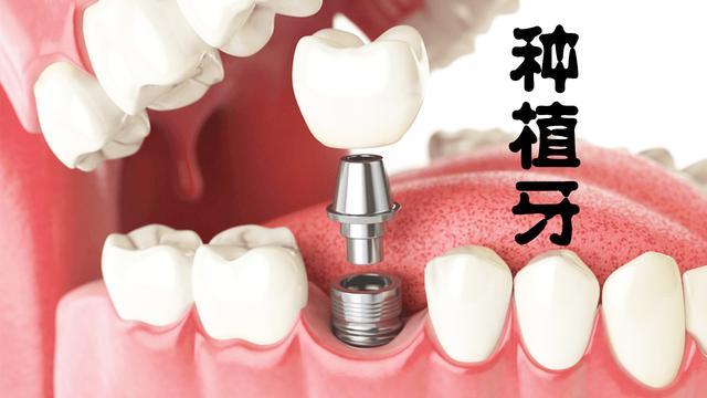 牙槽骨萎缩假牙老掉，种植牙技术怎么样？口碑评价如何，是否值得尝试？(图1)