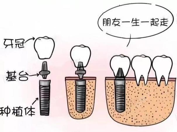2025韩国登腾种植牙价格表：