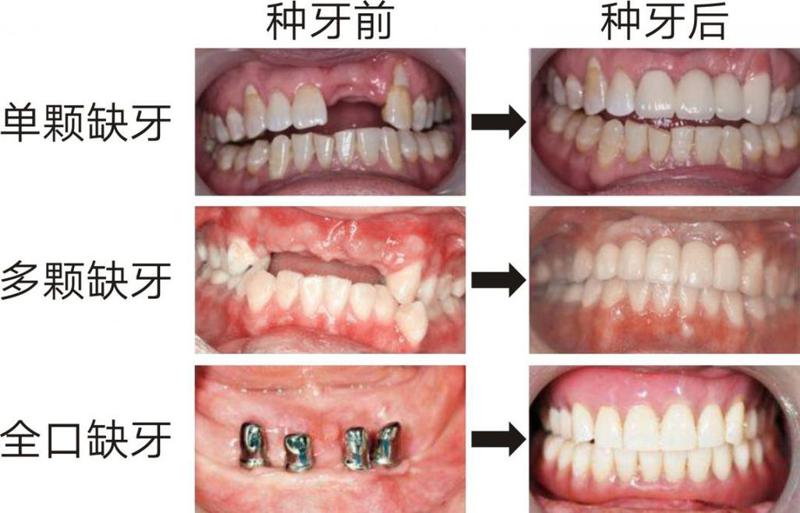 美国皓圣种植牙价格多少呢？花了15，000元一颗牙齿贵吗？