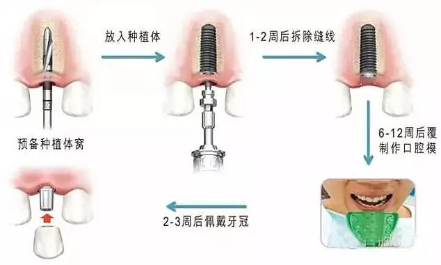 种植牙使用寿命如何延长？维护技术怎么样，口碑好不好？(图1)