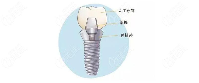 口腔科种牙多少钱价格揭晓，2025年价目表预览！
