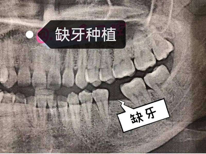 北京冠美口腔种植牙价格？种植牙步骤过程，使用时间！