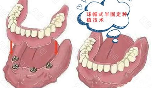 做了活动假牙后还能种牙吗？微创种植牙价格表，价格贵吗？(图1)