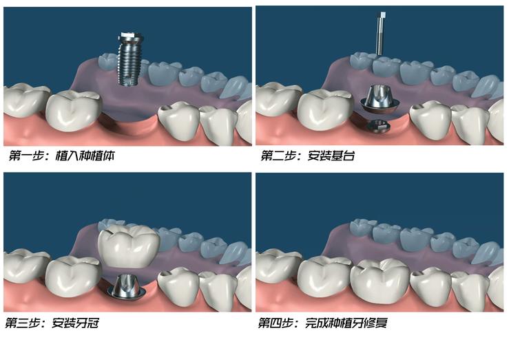 罗湖医院口腔种植怎么样：三甲医院实力，医生专业度如何？(图1)