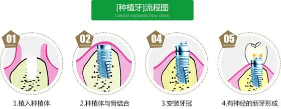 种植牙几年后牙床全烂的原因解析，技术问题和个人护理哪个更重要？