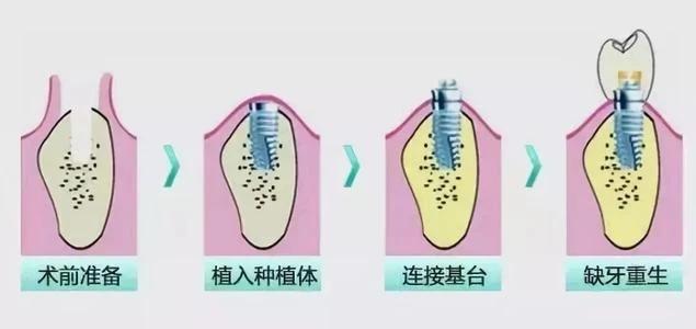 哈尔滨美植口腔种植牙好吗？了解医生推荐、医院信息