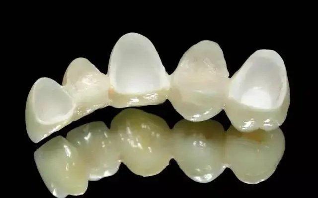 拔牙后镶牙费用多少？活动义齿与种植牙价格表一览，哪种更划算？