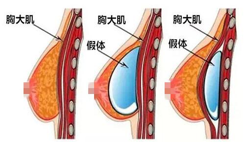自体脂肪隆胸我的经历过程，自体脂肪隆胸方式怎么样呢？(图1)