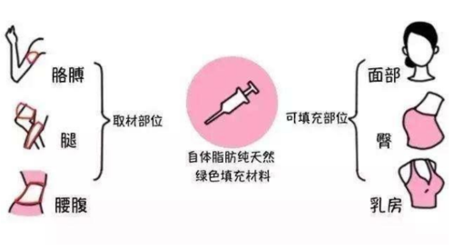 温州梦露国际整形医院做脂肪丰胸项目好吗？温州梦露脂肪丰胸案例分享！