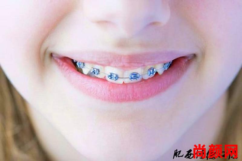 牙齿矫正器要带多久-牙齿矫正器要带多久才能摘