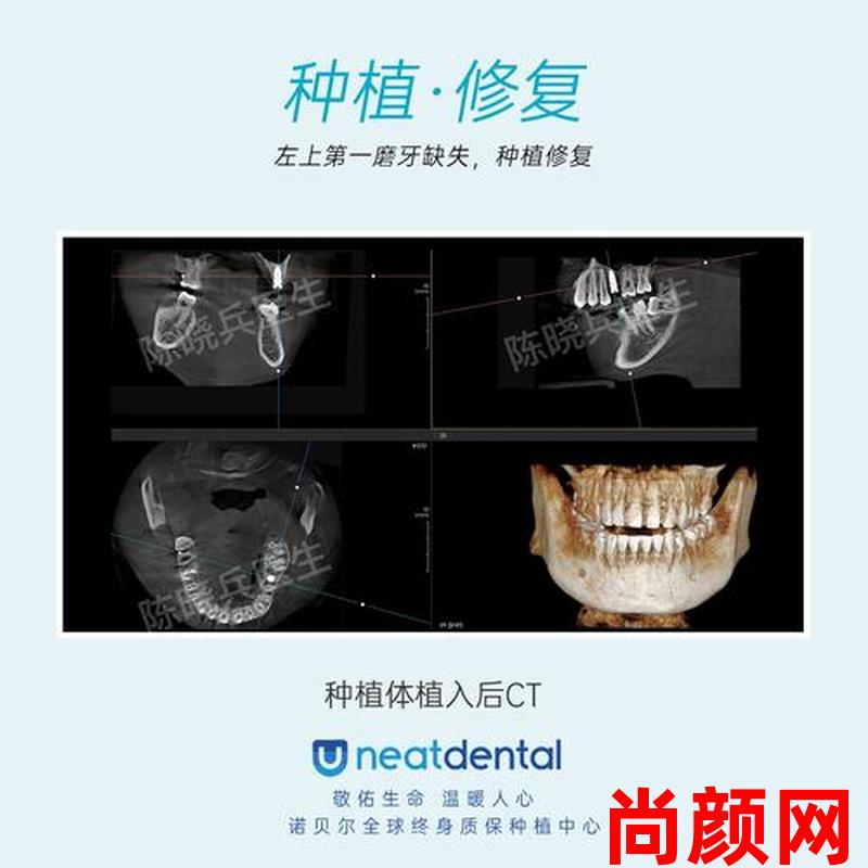 3D打印种植牙2016年能实现吗,3d打印种植牙2016年能实现吗知乎