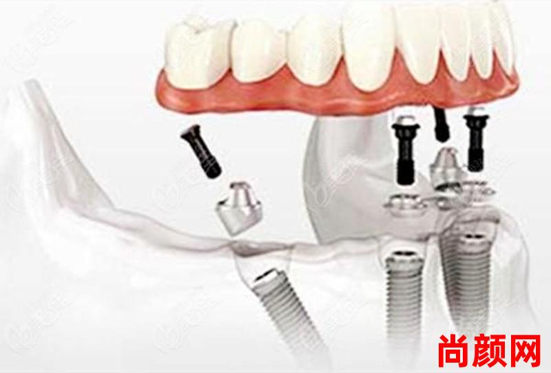 allon4种植牙是什么意思;allon4种植牙的风险有多大