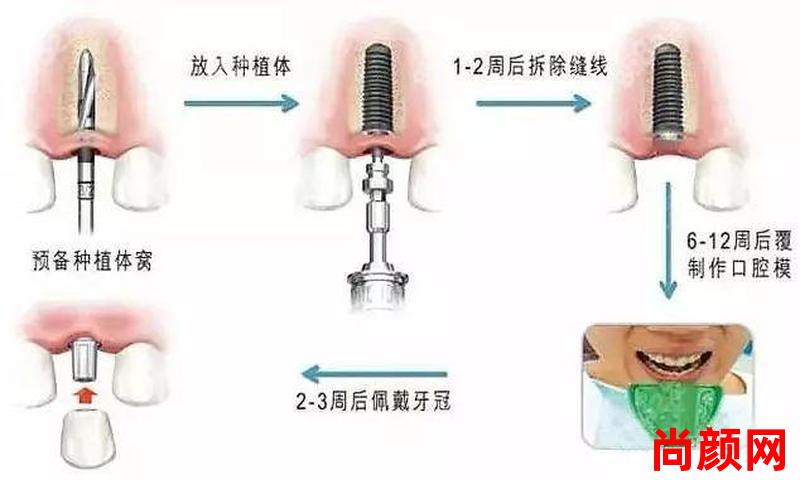 拔牙后三个月再种植牙,拔牙后三个月再种植牙好吗