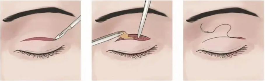 眼部整形
