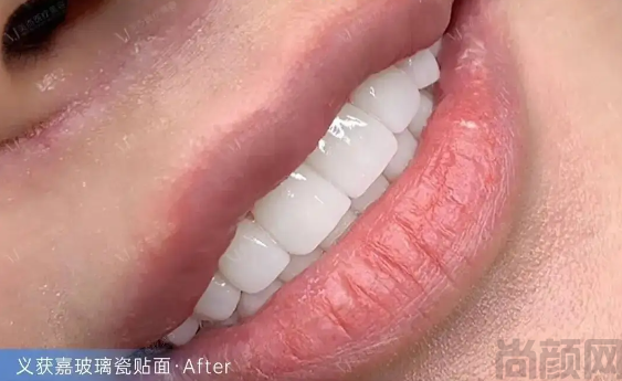义获嘉全瓷牙是哪国的产品?义获嘉全瓷牙的市场表现如何？！