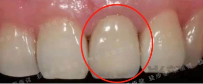 全瓷牙密合不好的图片，如何解决全瓷牙密合不好的问题