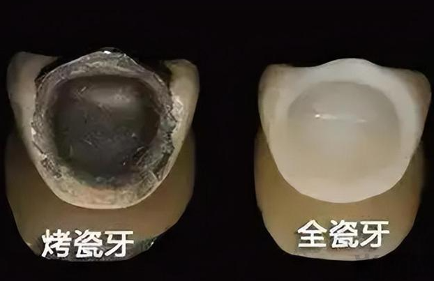 磨小了牙做全瓷牙真牙会烂吗?磨小了牙做全瓷牙对真牙的影响