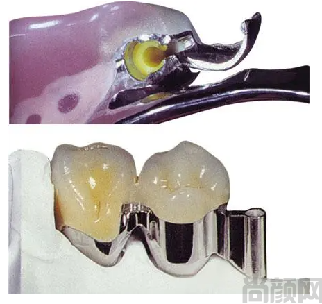 精密附着体义齿的优点和特点,维护和保养(图1)