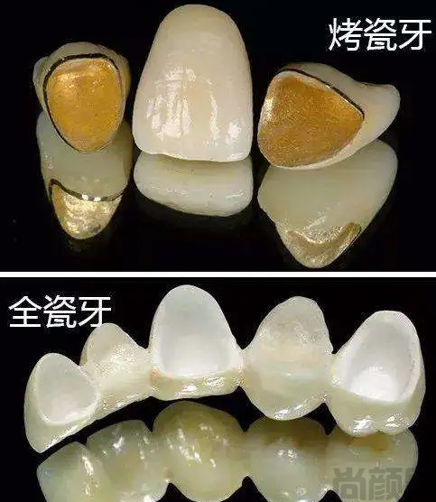 烤瓷牙与全瓷牙的区别和优缺点