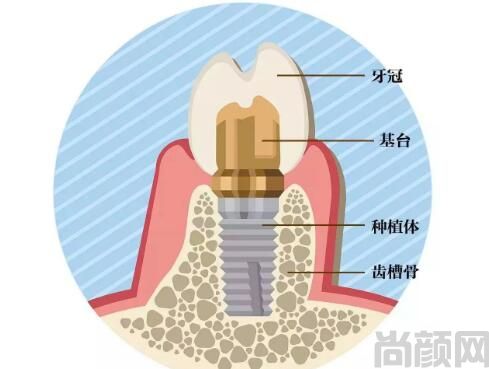 省口腔医院种牙价格贵吗?2023价格表一览,包括单颗,半口以及全口种牙等项目价格