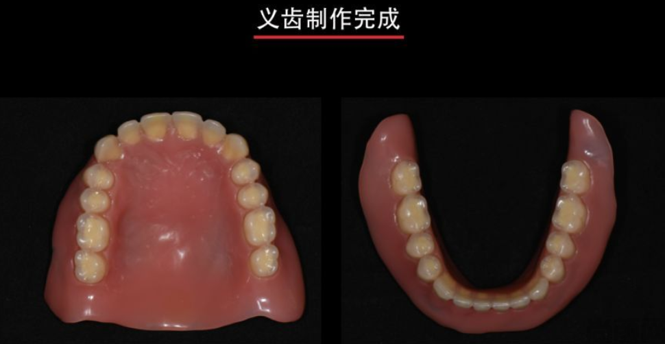老人全口假牙价目表,全口假牙的材料有哪些