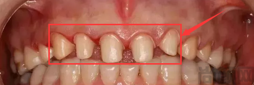 磨小了牙做全瓷牙真牙会烂吗？