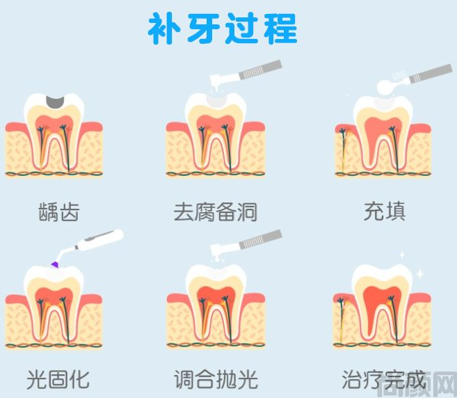补牙用什么材料好，选卡瑞斯玛树脂补牙还是3M？(图1)
