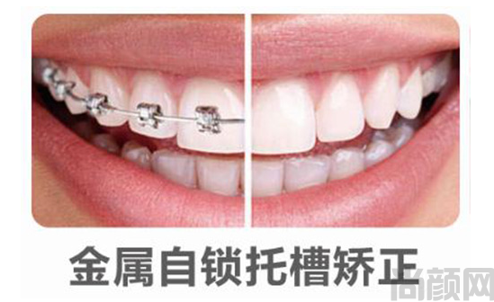 自锁托槽矫正是什么？自锁托槽矫正的原理和优势(图1)