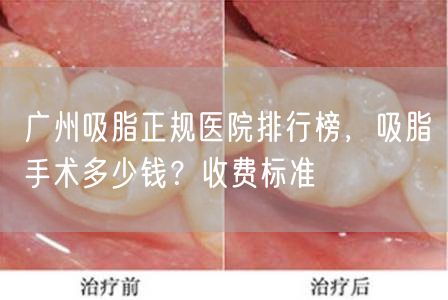 广州吸脂正规医院排行榜，吸脂手术多少钱？收费标准